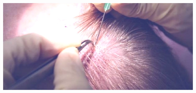 طريقة زراعة الشعر