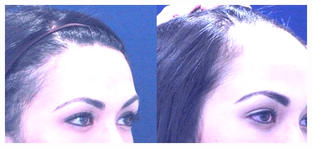 طرق زراعة الشعر